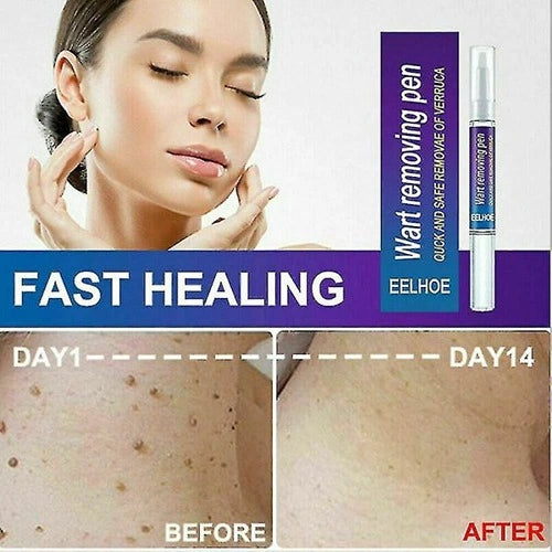 Wart Remover Gel Pen