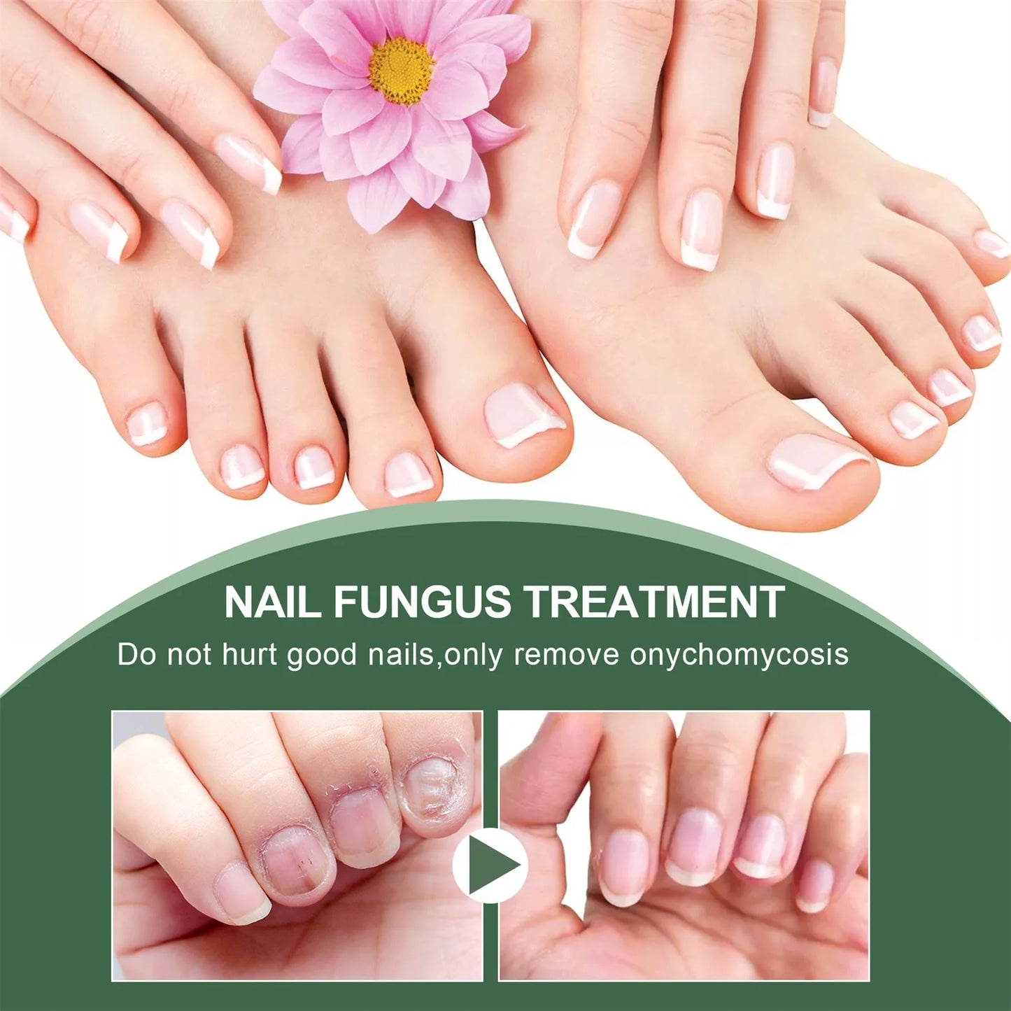 Nail Fungus Serum