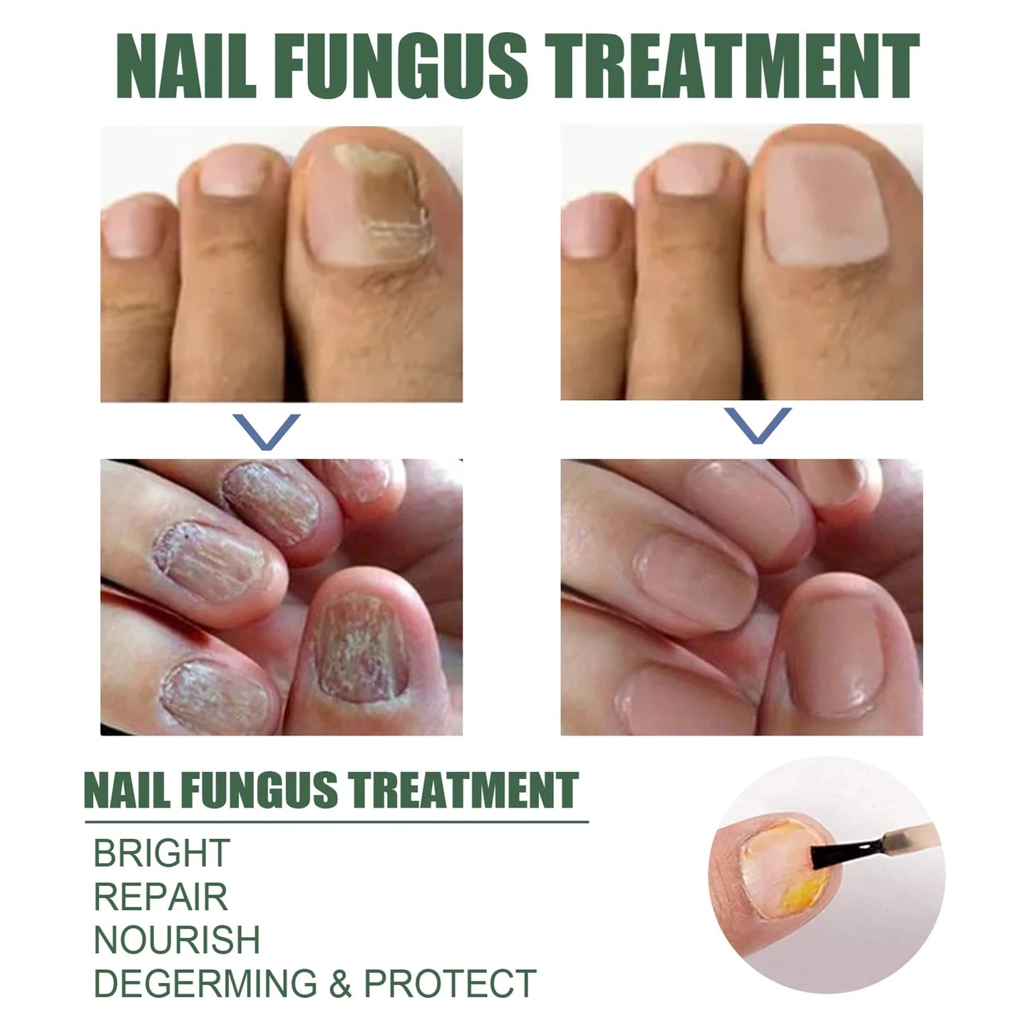 Nail Fungus Serum