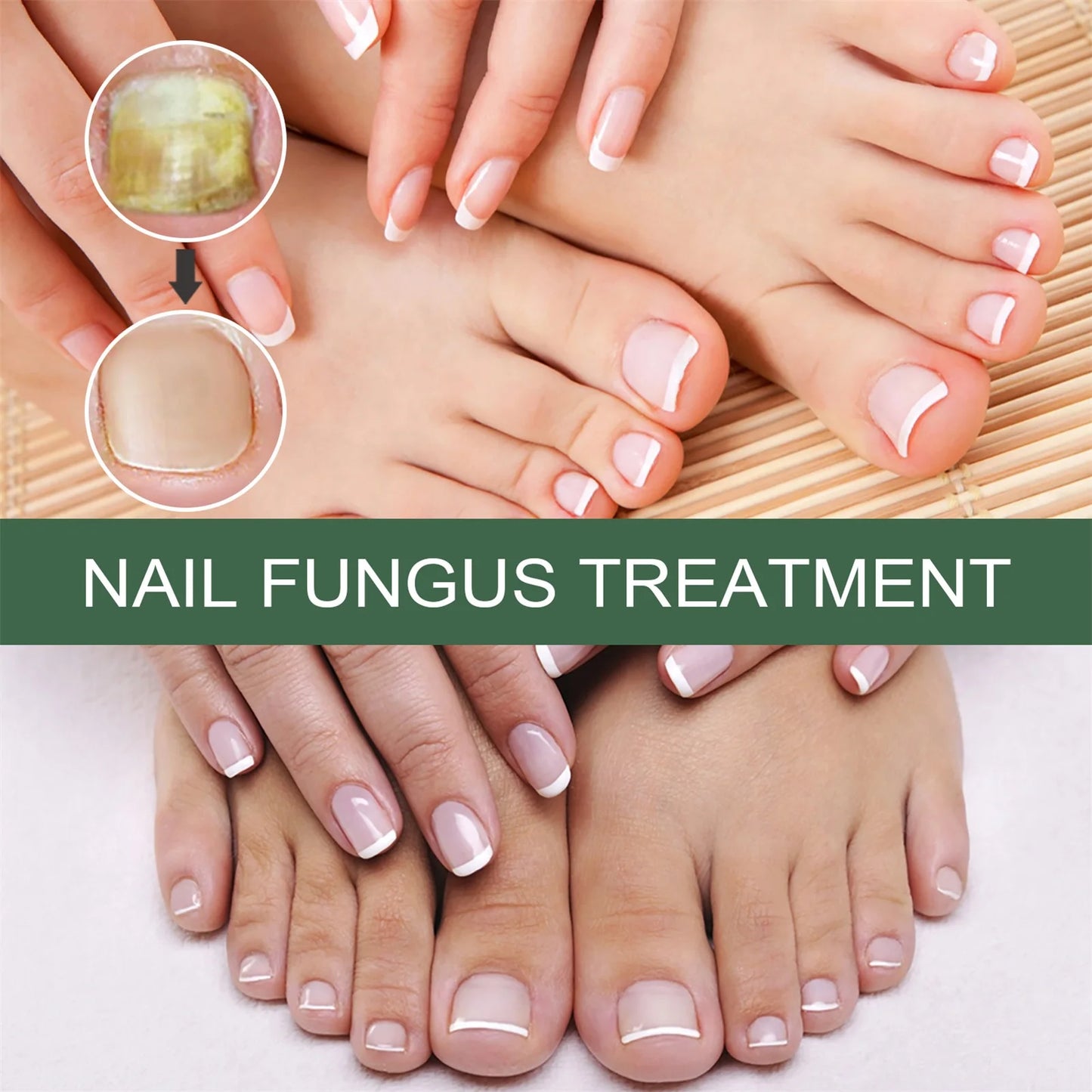 Nail Fungus Serum